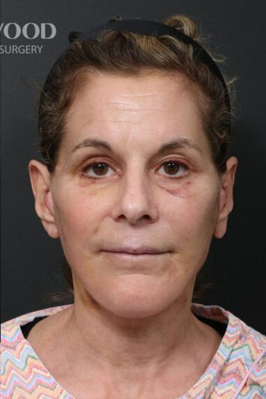 Deep Plane Facelift (SMAS and retaining ligaments) — after