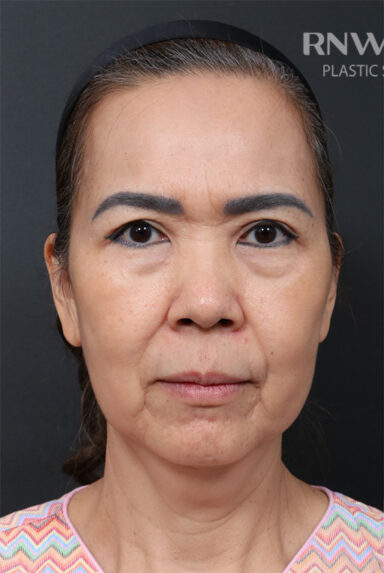 Deep Plane Facelift (SMAS and retaining ligaments) — before