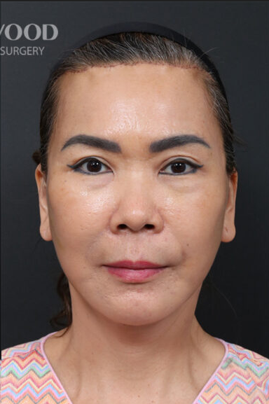 Deep Plane Facelift (SMAS and retaining ligaments) — after