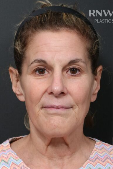 Deep Plane Facelift (SMAS and retaining ligaments) — before