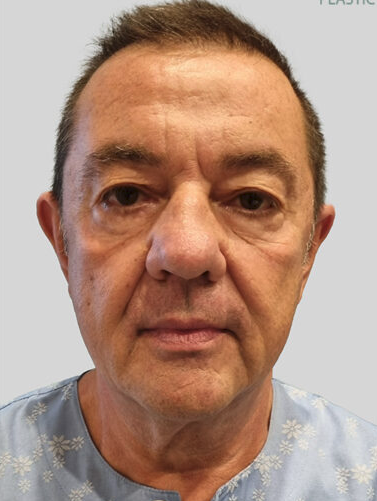 Deep Plane Facelift (SMAS and retaining ligaments) — before