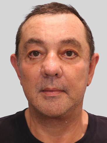 Deep Plane Facelift (SMAS and retaining ligaments) — after