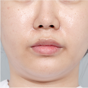 Ultherapy 300 shots + Rejuran 4cc & Ultherapy + Titanium Lifting + Skin Botox & Ultherapy 400 shots + Thermage Lifting 600 shots — before (Lifting Laser (1 month B&A))