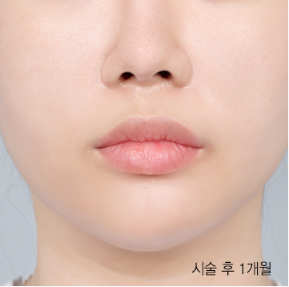 Ultherapy 300 shots + Rejuran 4cc & Ultherapy + Titanium Lifting + Skin Botox & Ultherapy 400 shots + Thermage Lifting 600 shots — after (Lifting Laser (1 month B&A))