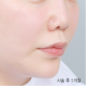 Ultherapy 300 shots + Rejuran 4cc & Ultherapy + Titanium Lifting + Skin Botox & Ultherapy 400 shots + Thermage Lifting 600 shots — after (Lifting Laser (1 month B&A))