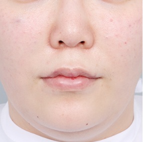 Ultherapy 300 shots + Rejuran 4cc & Ultherapy + Titanium Lifting + Skin Botox & Ultherapy 400 shots + Thermage Lifting 600 shots — before (Lifting Laser (1 month B&A))