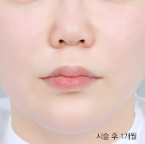 Ultherapy 300 shots + Rejuran 4cc & Ultherapy + Titanium Lifting + Skin Botox & Ultherapy 400 shots + Thermage Lifting 600 shots — after (Lifting Laser (1 month B&A))