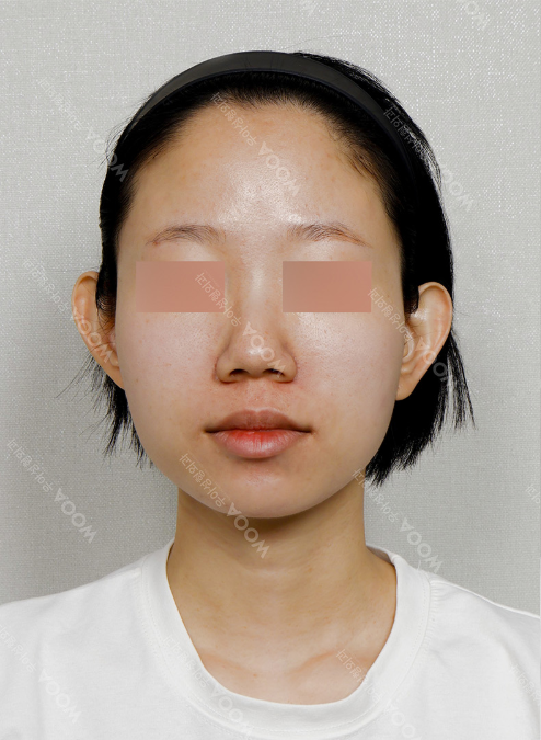 WOOA Titanium 1 Day Lifting — before