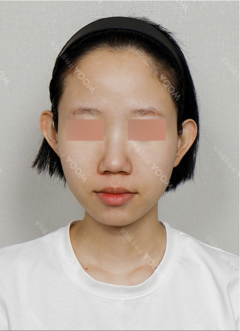 WOOA Titanium 1 Day Lifting — after