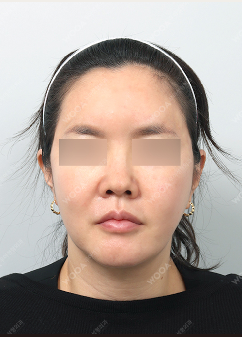 WOOA Titanium 1 Day Lifting — before