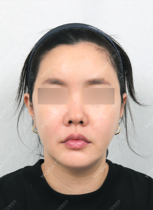 WOOA Titanium 1 Day Lifting — after