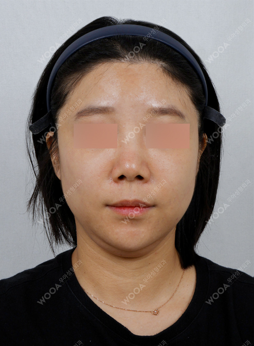 WOOA Titanium 1 Day Lifting — before