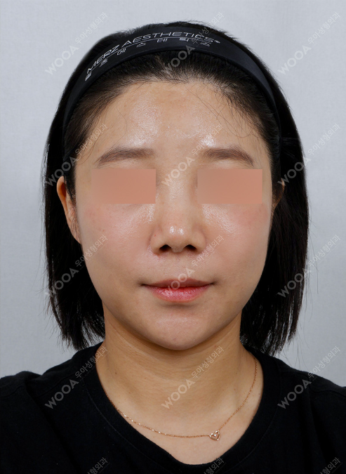 WOOA Titanium 1 Day Lifting — after