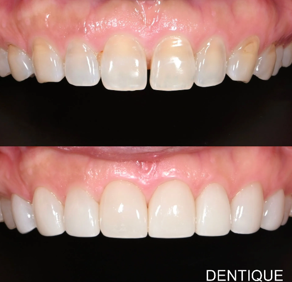Zero Veneer (ultra-thin porcelain veneers designed to require little to no tooth shaving before placement) — before