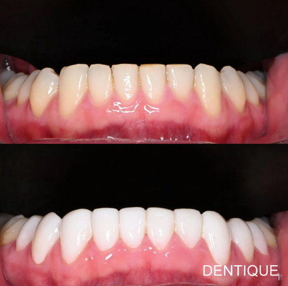 Zero Veneer (ultra-thin porcelain veneers designed to require little to no tooth shaving before placement) — after