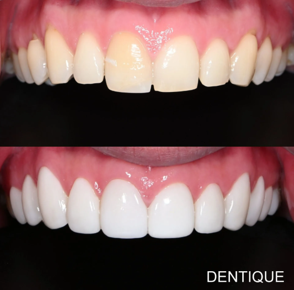 Zero Veneer (ultra-thin porcelain veneers designed to require little to no tooth shaving before placement) — before