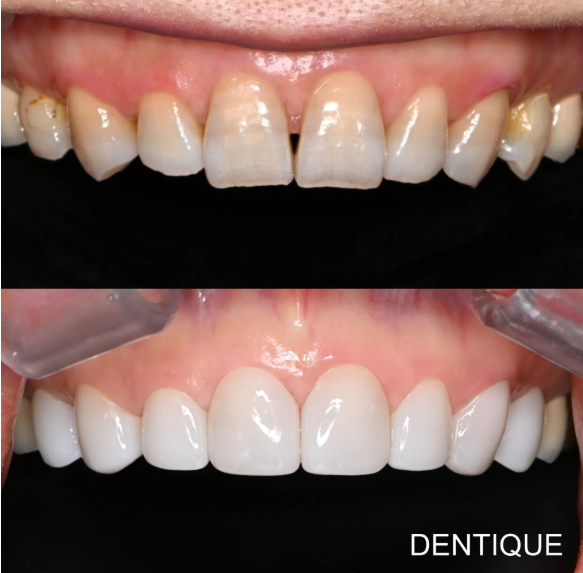 Zero Veneer (ultra-thin porcelain veneers designed to require little to no tooth shaving before placement) — after