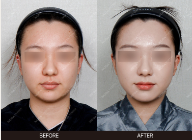 Xerf — before