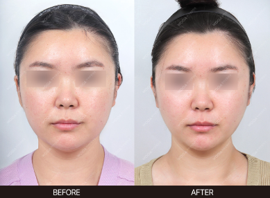 Xerf — before