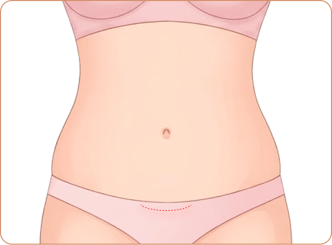 Mini Tummy Tuck: Step 1