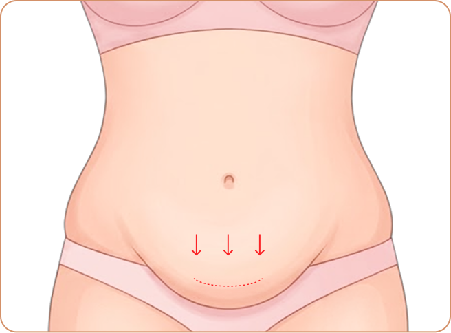 Mini Tummy Tuck: Step 2