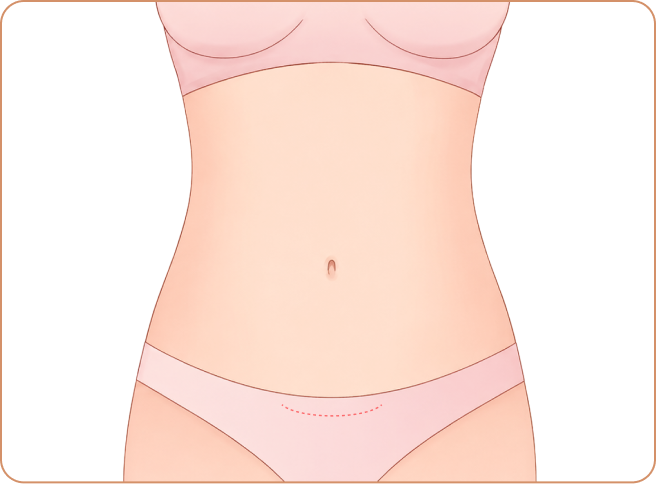 Mini Tummy Tuck: Step 3