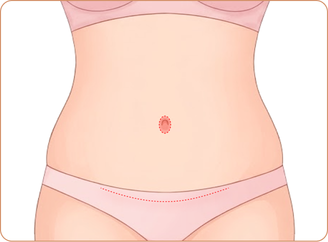 Full Tummy Tuck Best For: Overall sagging + muscle separation; Step 1