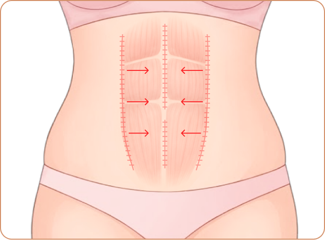 Full Tummy Tuck Best For: Overall sagging + muscle separation; Step 2