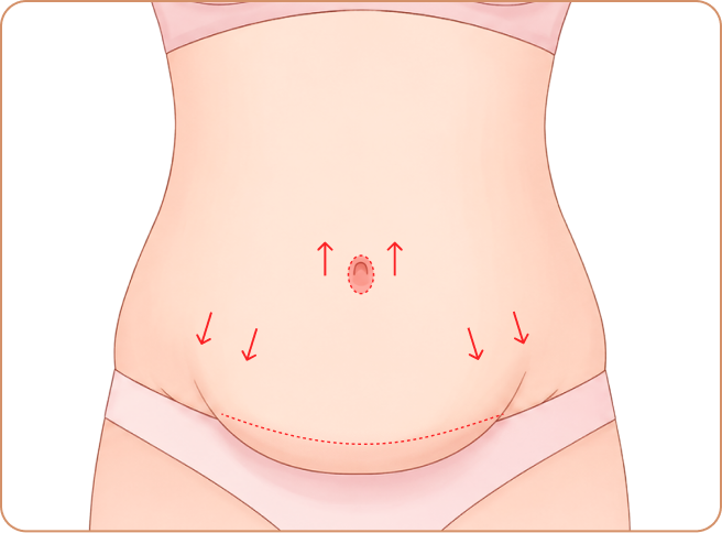 Full Tummy Tuck Best For: Overall sagging + muscle separation; Step 3