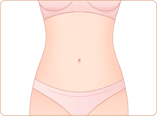 Full Tummy Tuck Best For: Overall sagging + muscle separation; Step 4
