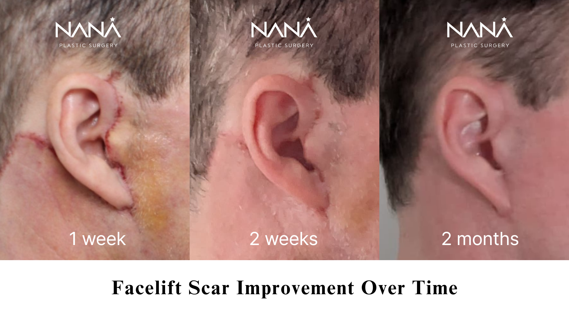 Scar-Minimal Incisions for Natural Results