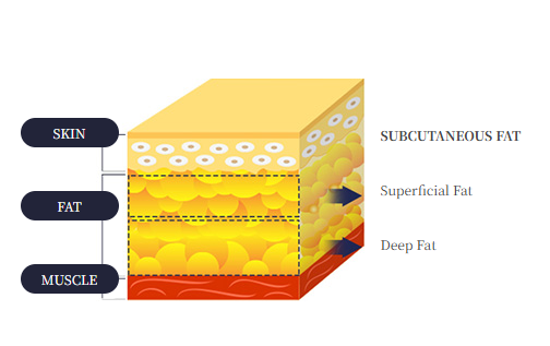 Subcutaneous Fat Removal