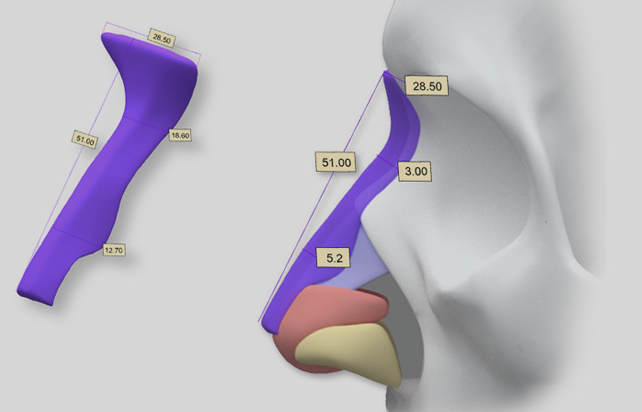 3D Printed Custom Nose Cartilage