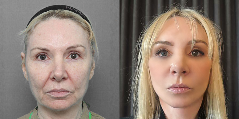 What is NANA’s Deep Plane Facelift Surgery?