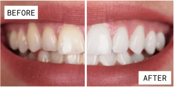 Why Patients Choose Korea for Zero Veneers
